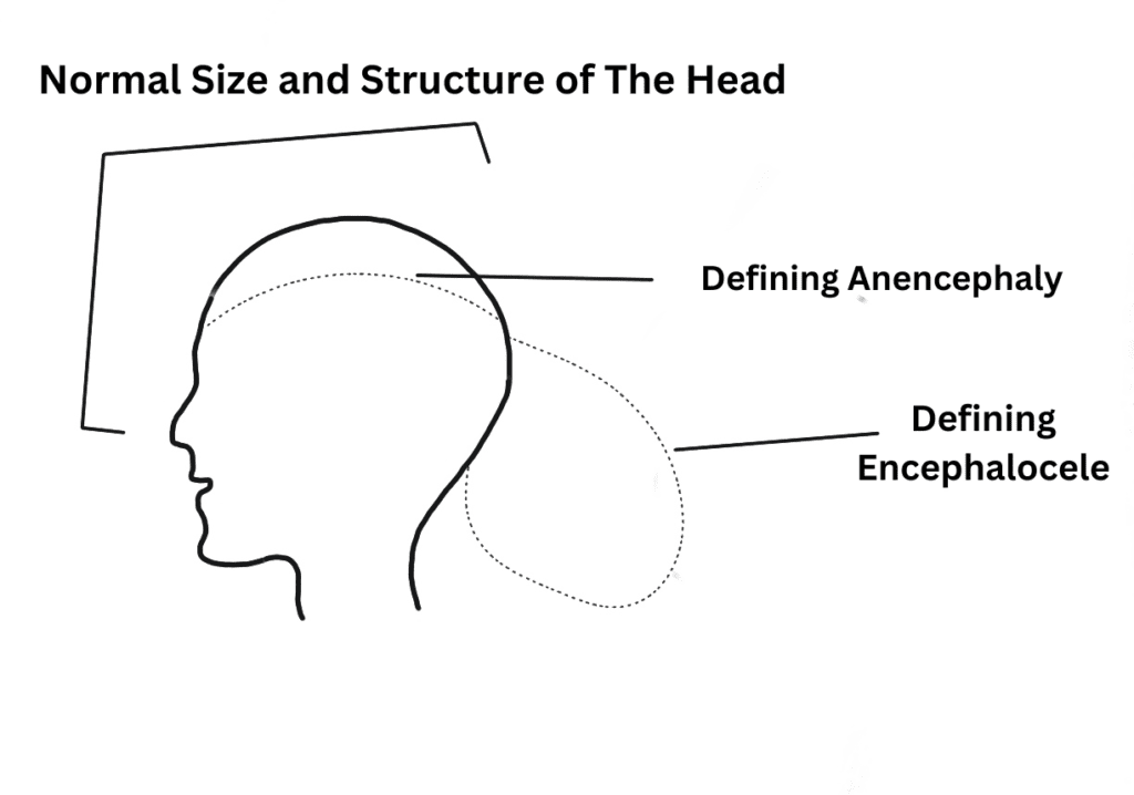 Anencephaly and encephalocele diagrams and morphology