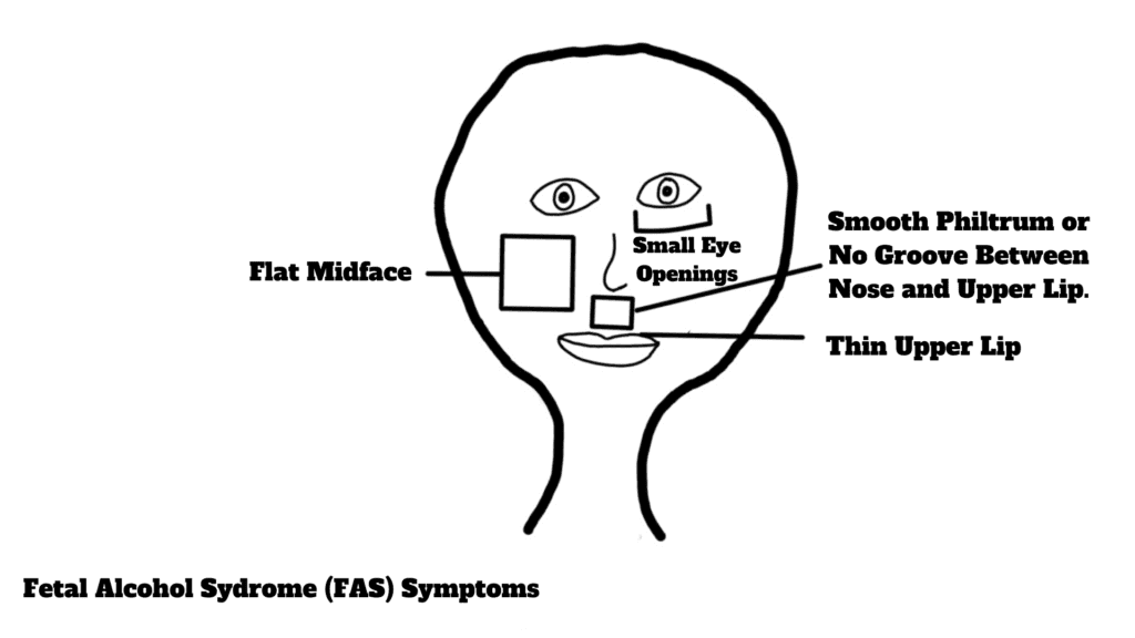 Symptoms of Fetal alcohol syndrome  FAS. 
