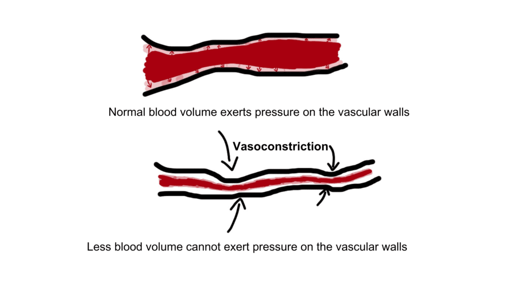 Vasoconstriction is a compensatory mechanism in combating severe dehydrations